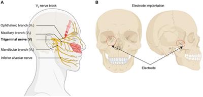 Digital subtraction angiography-guided peripheral nerve stimulation via the foramen rotundum for refractory trigeminal postherpetic neuralgia: a case report and literature review